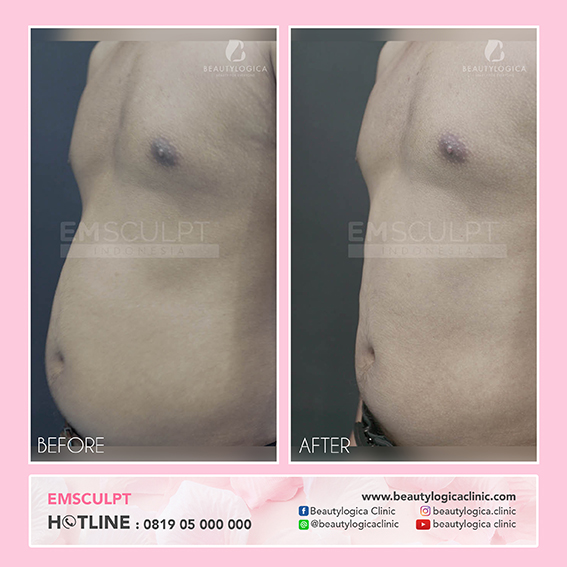 BEFORE AFTER EMSCULPT