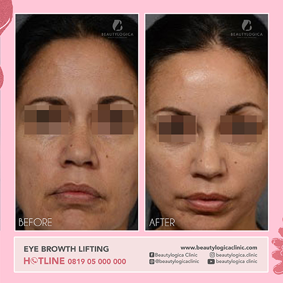Before After Eyebrow Lifting