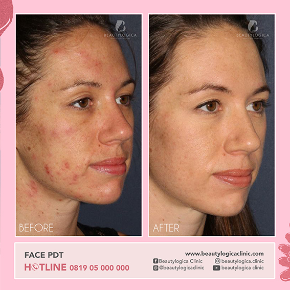 BEFORE & AFTER