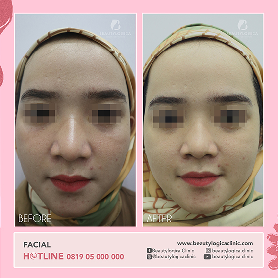 BEFORE AFTER FACIAL TREATMENT