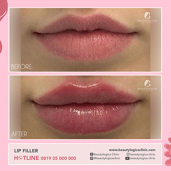 Filler Bibir Before After di Klinik Kecantikan