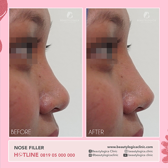 Apa itu Filler? Lihat Before Afternya di Sini