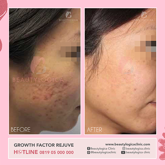 BEFORE & AFTER GROWTH FACTOR REJUVE