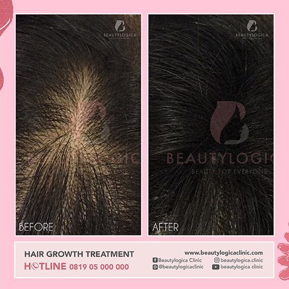 BEFORE AFTER HAIR GROWTH FACTOR