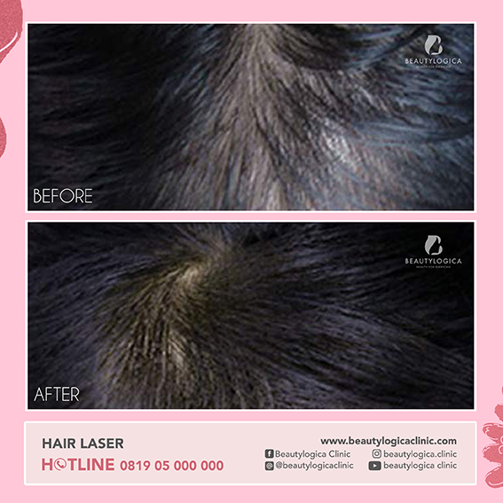 BEFORE AFTER HAIR LASER PDT