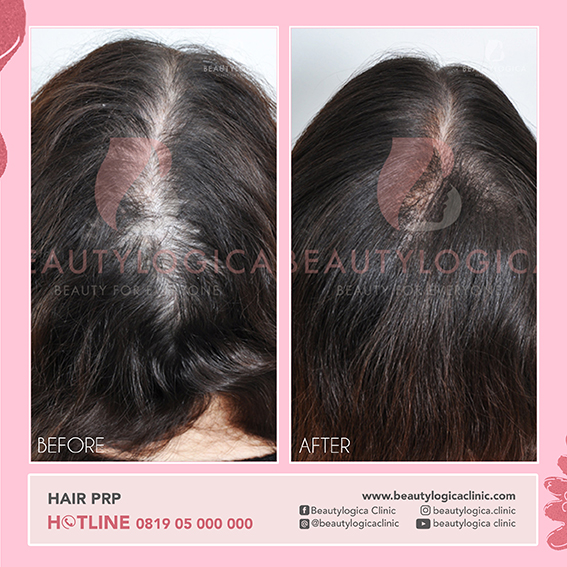 BEFORE AFTER HAIR PRP