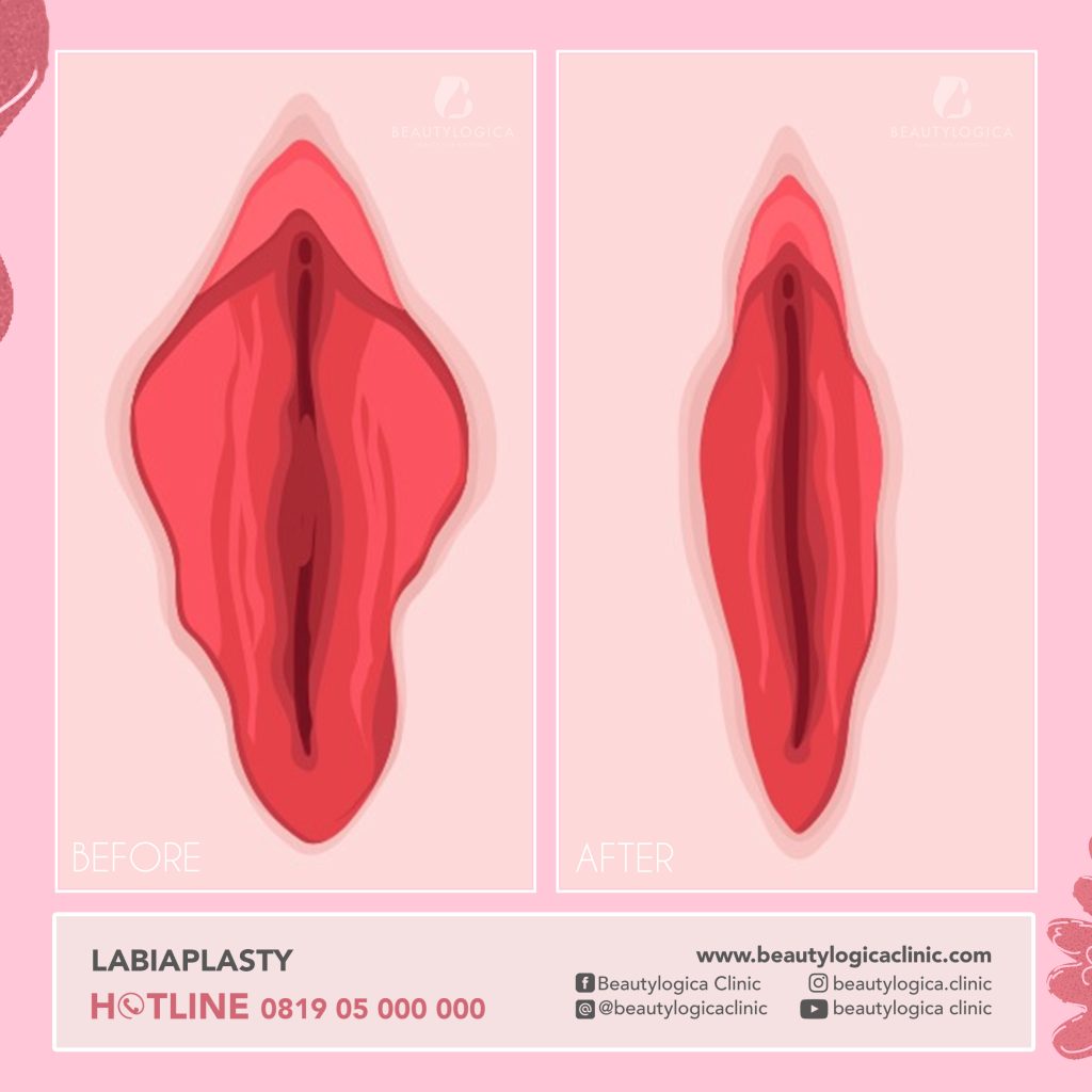 BEFORE AFTER LABIAPLASTY