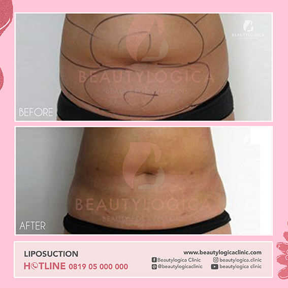 BEFORE AFTER LIPOSUCTION - SEDOT LEMAK