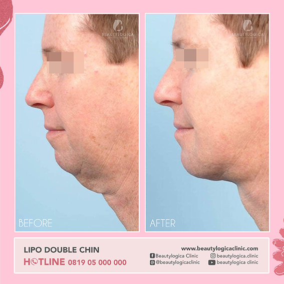 BEFORE AFTER LIPO DOUBLE CHIN - cara menghilangkan lemak di bawah dagu