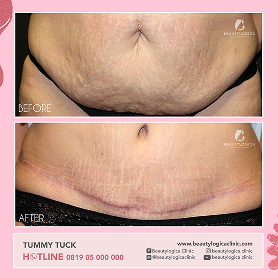 BEFORE AFTER TUMMY TUCK