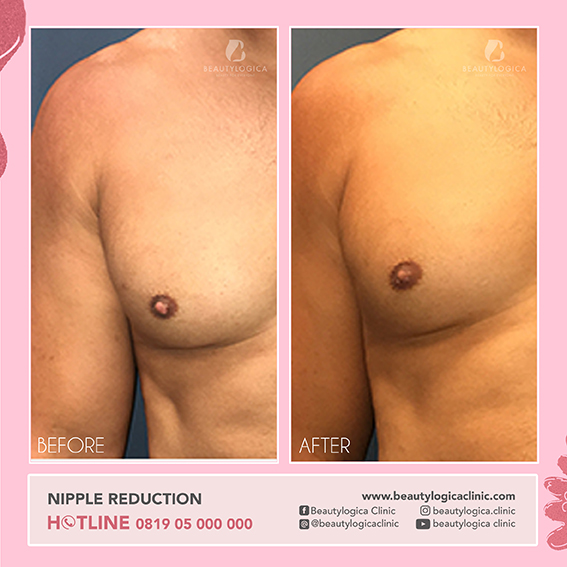 BEFORE AFTER NIPPLE REDUCTION - cara mengecilkan puting