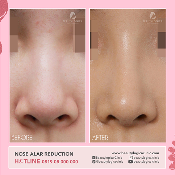 BEFORE AFTER NOSE ALAR REDUCTION - Operasi Mengecilkan Cuping Hidung
