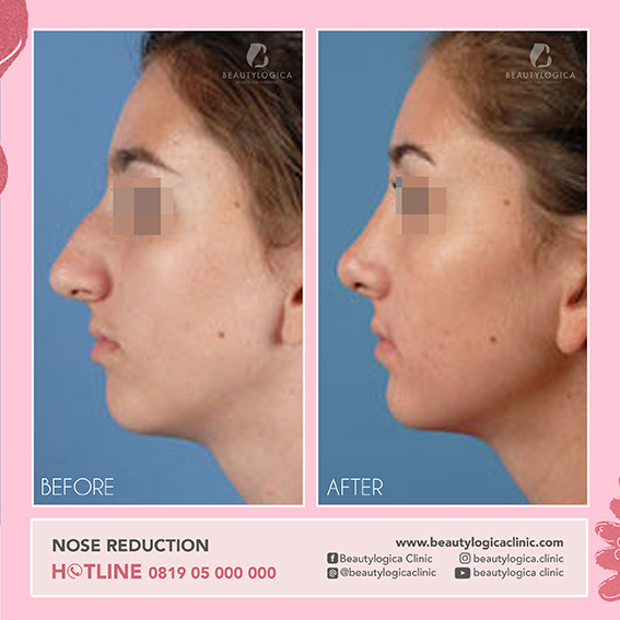 BEFORE AFTER Nose Reduction - cara mengecilkan ujung hidung yang besar