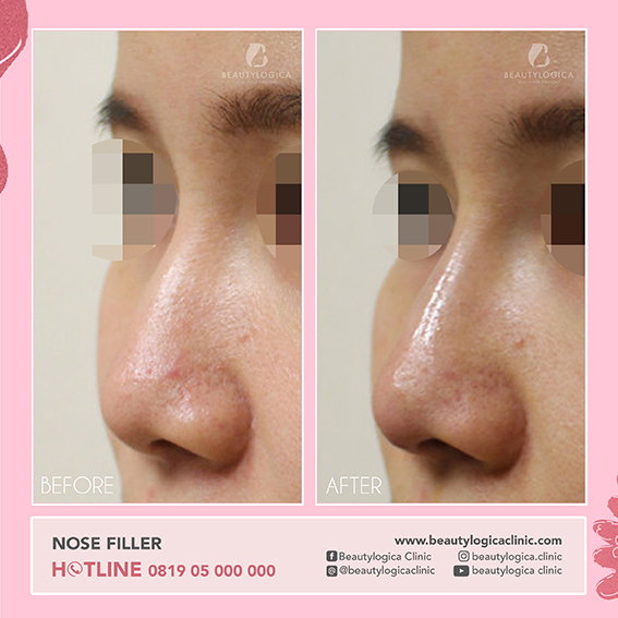 Before After Nose Thread Lift