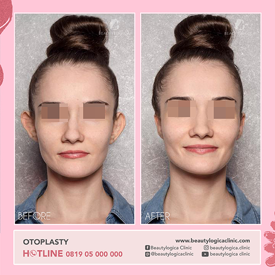 BEFORE AFTER OTOPLASTY - OPERASI TELINGA