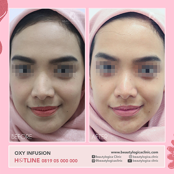BEFORE AFTER OXY INFUSION