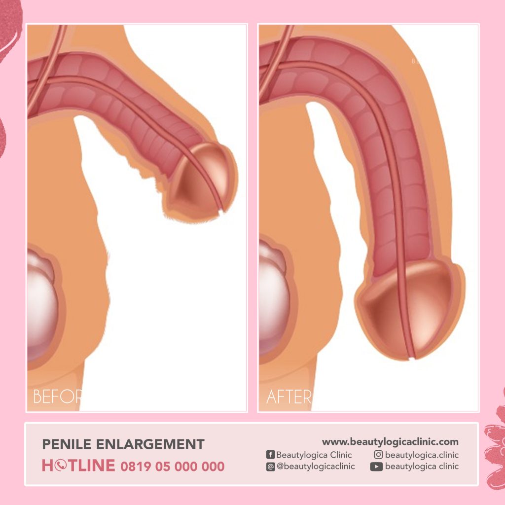 BEFORE & AFTER PENILE ENLARGEMENT - operasi pembesaran penis