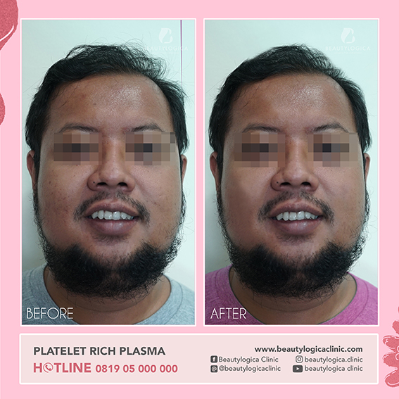 BEFORE & AFTER PRP