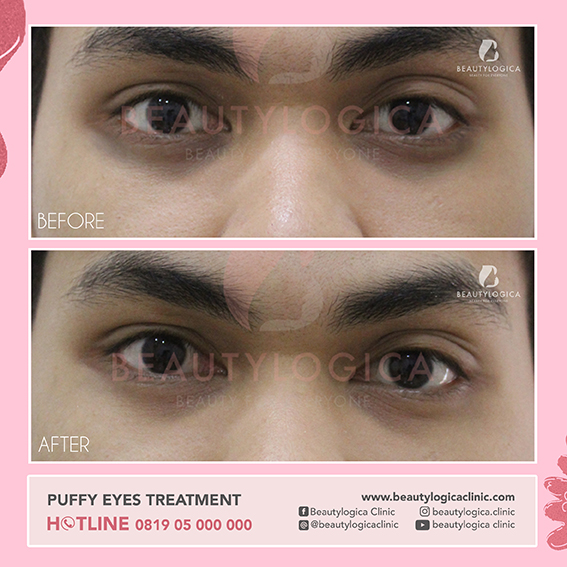 BEFORE & AFTER PUFFY EYES TREATMENT - perawatan mata panda