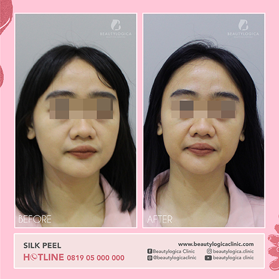 BEFORE AFTER SILK PEEL