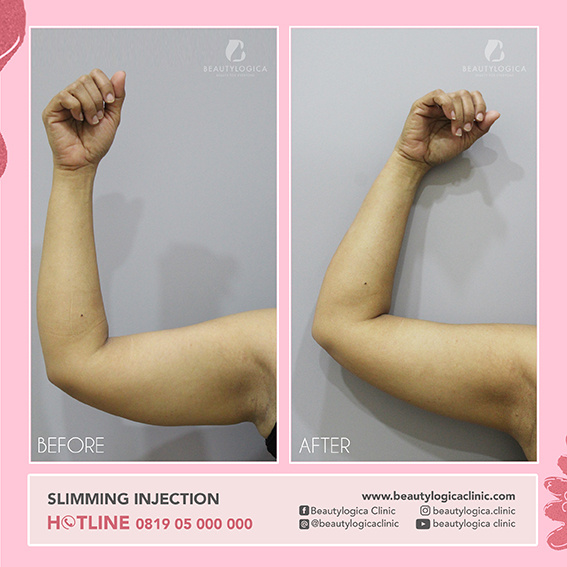 SLIMMING INJECTION BEFORE AFTER