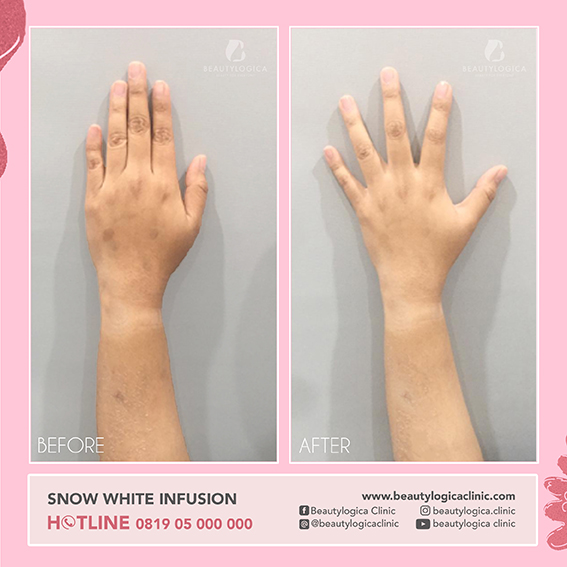 BEFORE AFTER SNOW WHITE INFUSION