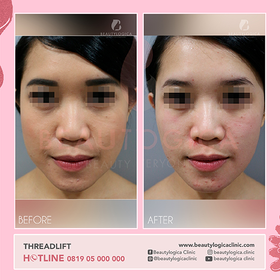 Hasil Thread Lift atau Tanam Benang