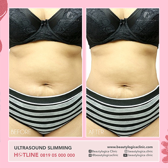 BEFORE AFTER ULTRASOUND SLIMMING
