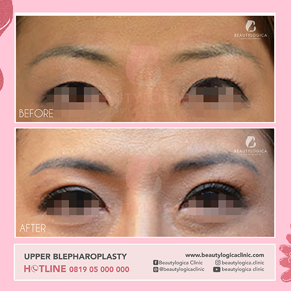 Upper Blepharoplasty - Operasi Lipatan Mata