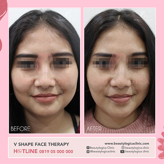BEFORE AFTER V SHAPE FACE THERAPY