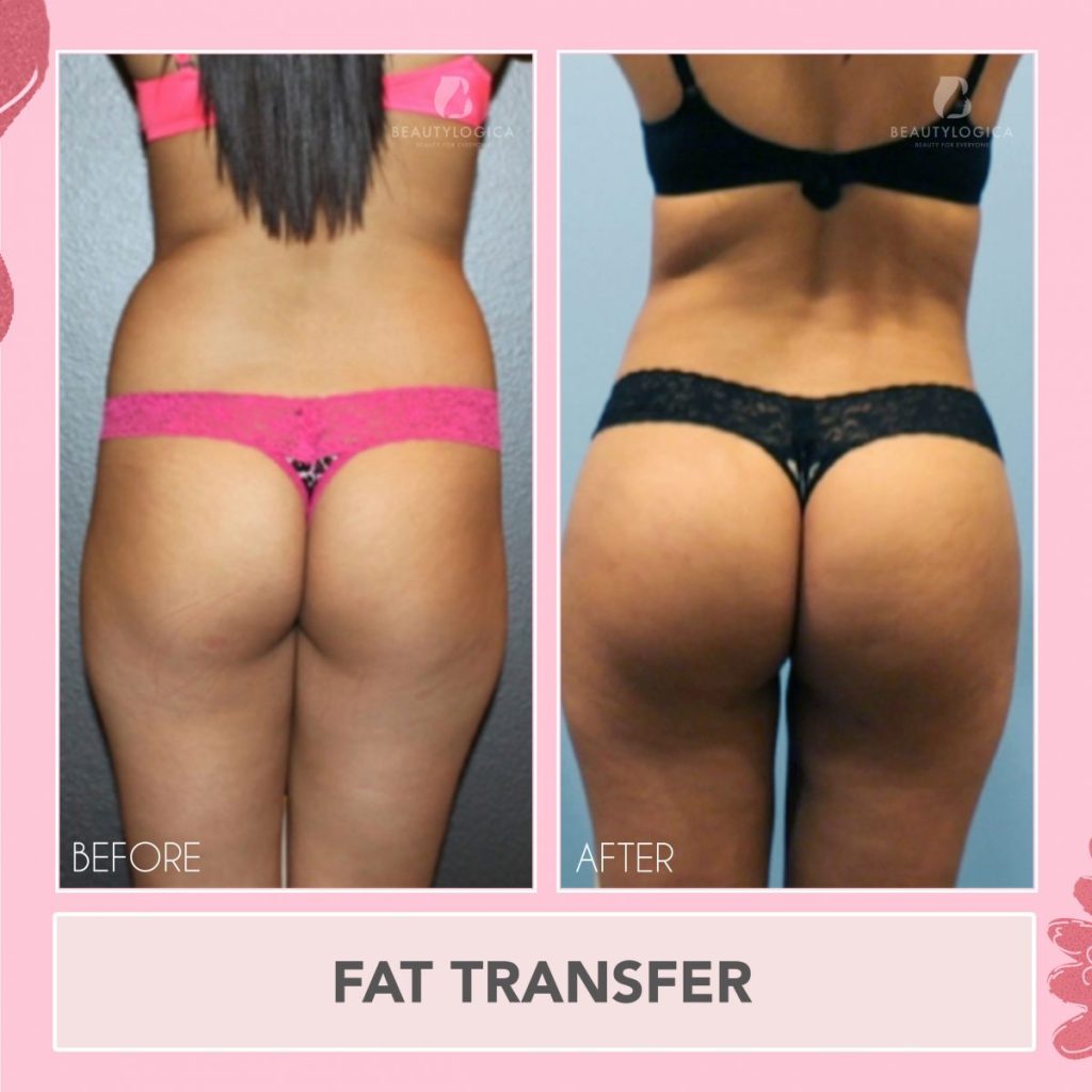 Before After Fat Transfer - Transfer Lemak