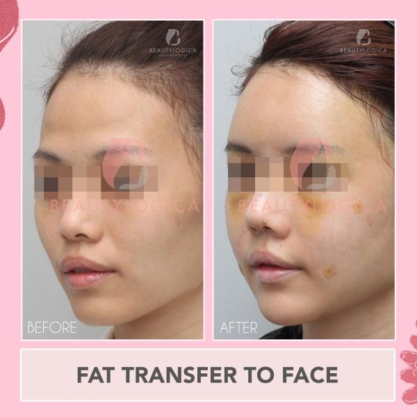 Klinik Kecantikan untuk Fat transfer Jakarta