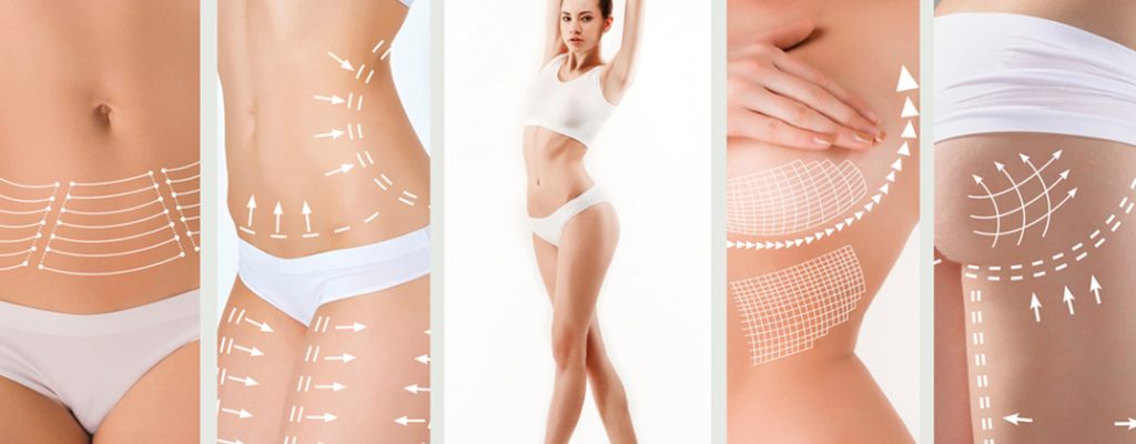LIPOSUCTION - SEDOT LEMAK