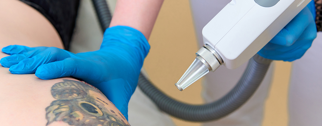 Laser Tato Laser Tato