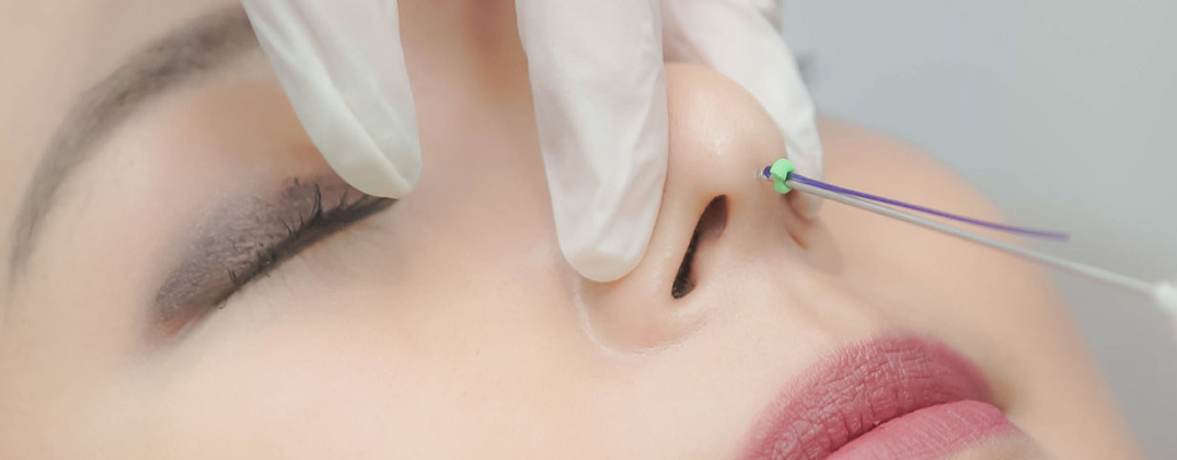 Nose Thread Lift Nose Thread Lift