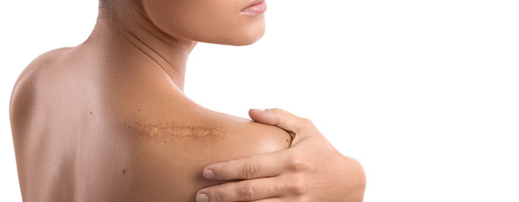 SCAR REVISION SCAR REVISION
