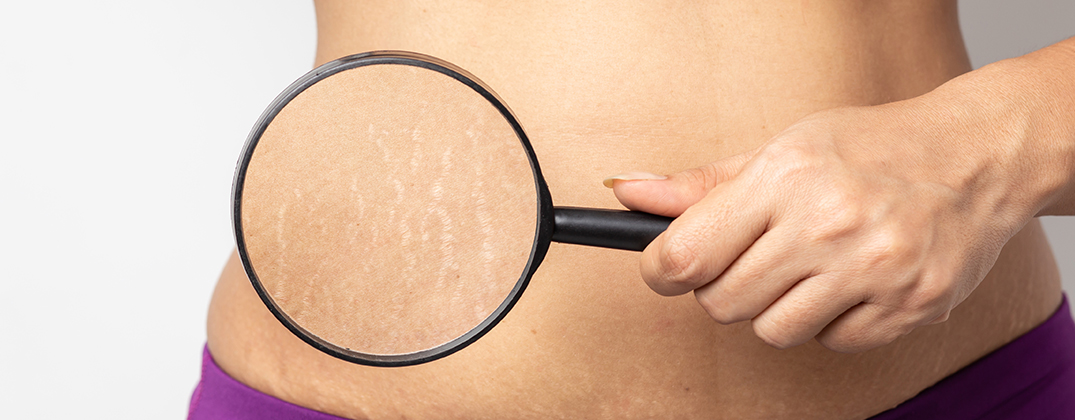 stretch mark stretch mark