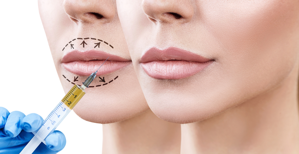 Prosedur Filler Bibir di Klinik Kecantikan