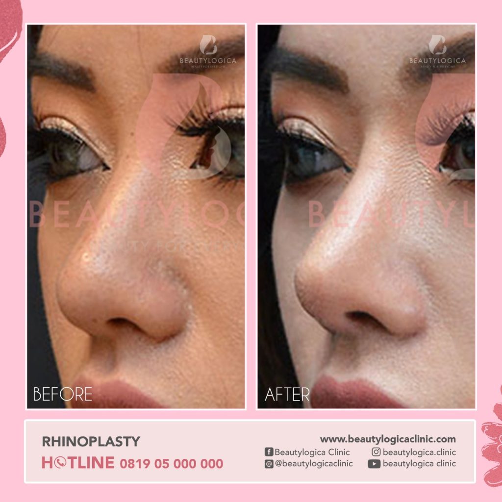 Review Operasi Hidung Terbaik di Jakarta