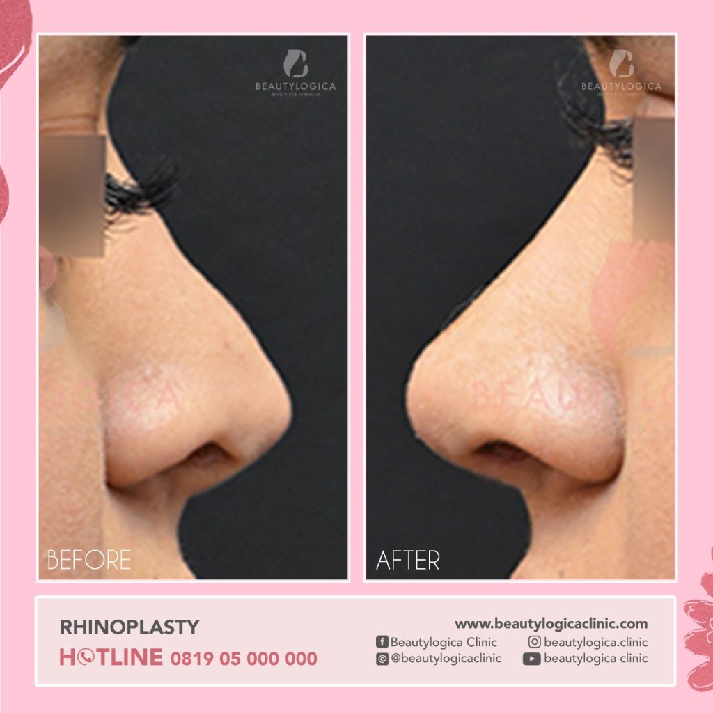 Operasi Hidung Terbaik dan Murah di Jakarta