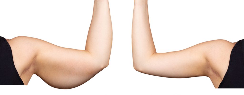 Brachioplasty Brachioplasty