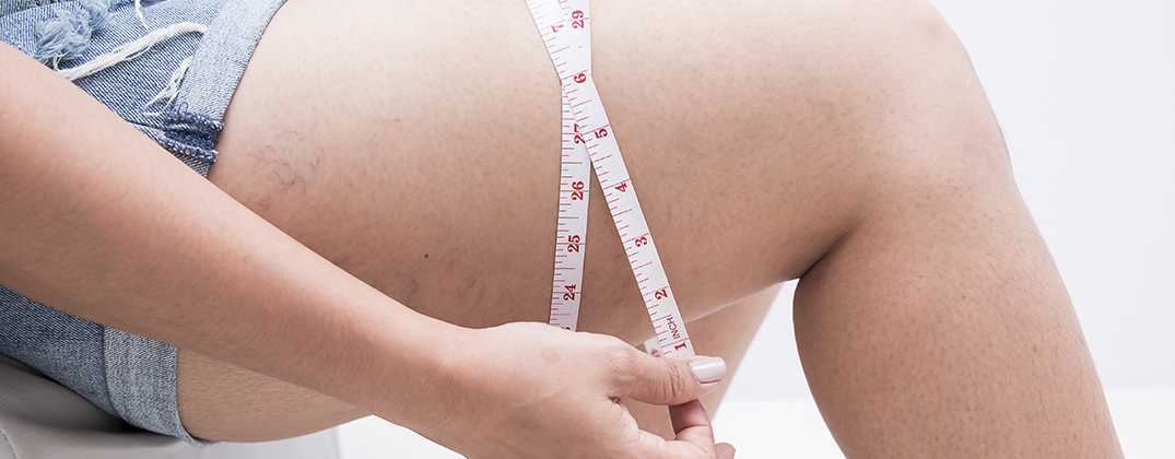 Thigh Lift Thigh Lift