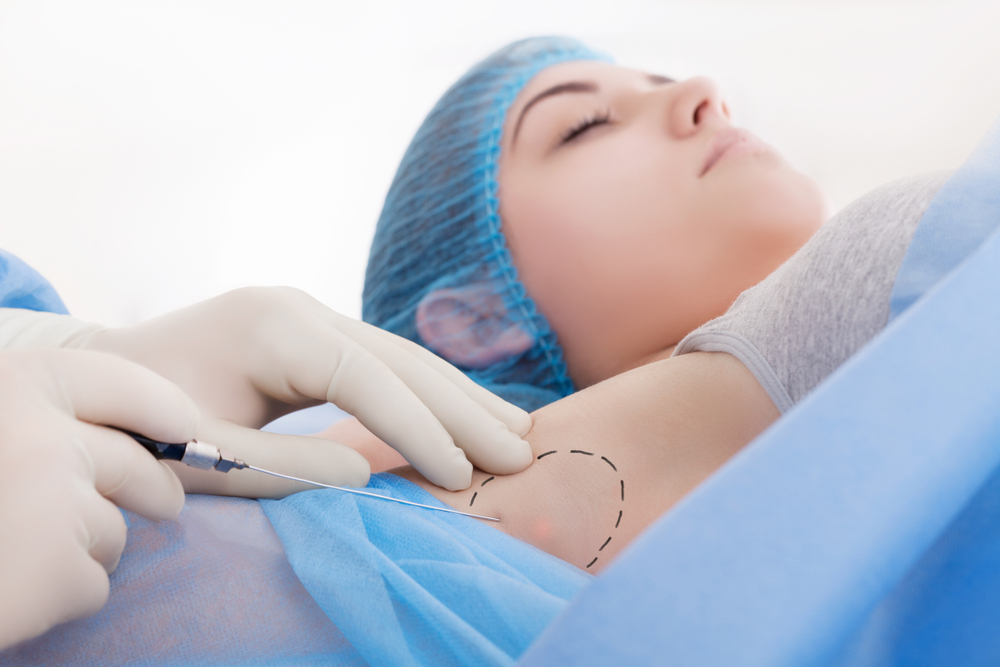 Suntik Botox untuk Keringat Berlebih
