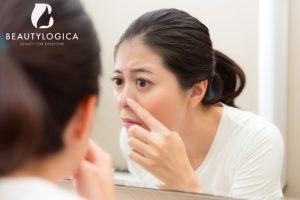 cara menghilangkan jerawat batu di hidung