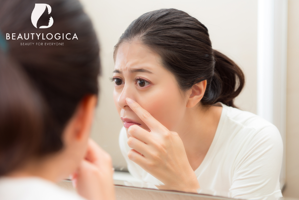 cara menghilangkan jerawat batu di hidung