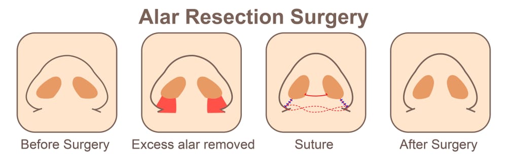 Cara memperkecil cuping hidung