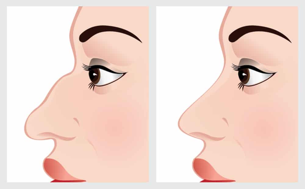 Memperkecil hidung dengan operasi