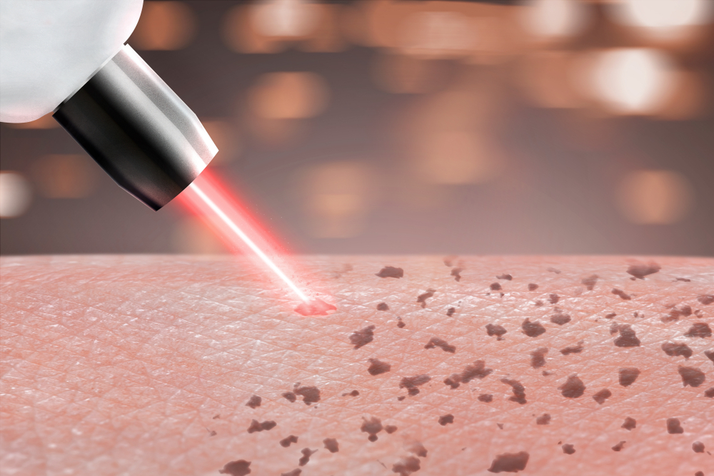 Prosedur dan Cara Kerja Perawatan Laser Wajah