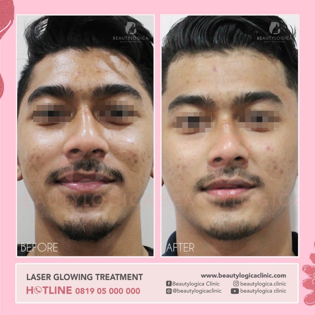 Laser Glowing Treatment Before After