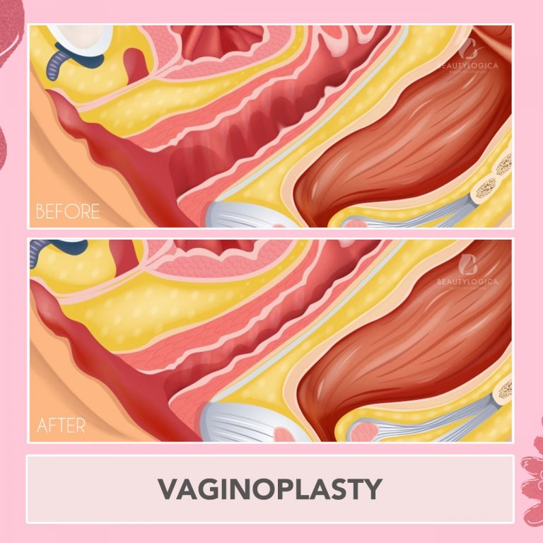 Before After Vaginoplasty